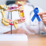 Colon Cancer Symptoms