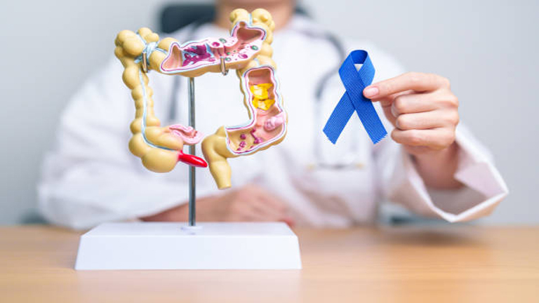 Colon Cancer Symptoms