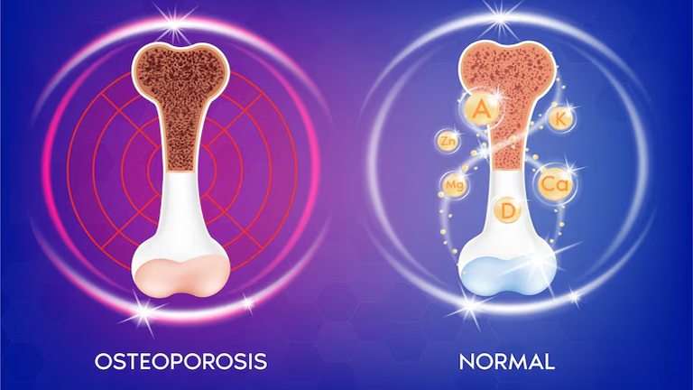 Osteoporosis Symptoms