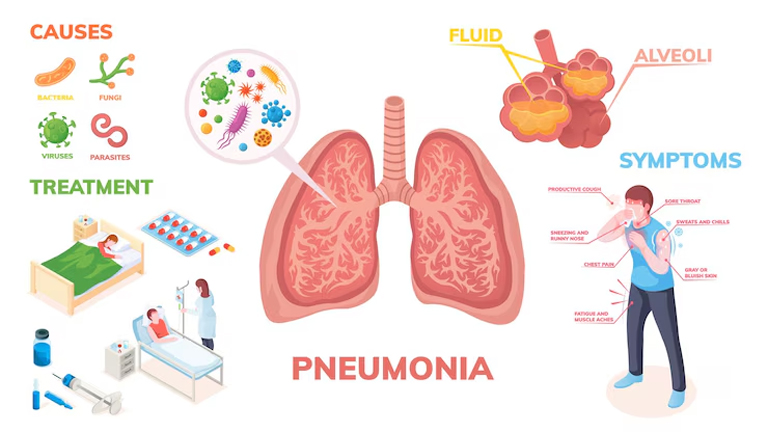 Pneumonia Symptoms