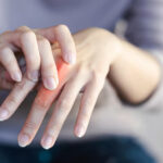 Rheumatoid Arthritis