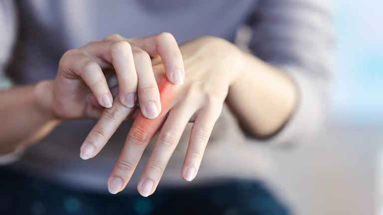 Rheumatoid Arthritis