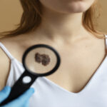Skin Cancer