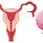Chlamydia