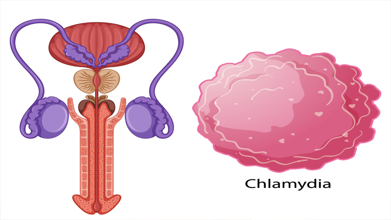 Chlamydia