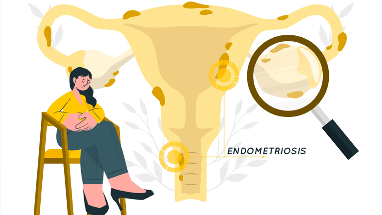 Endometriosis