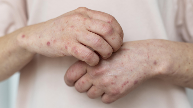 Folliculitis
