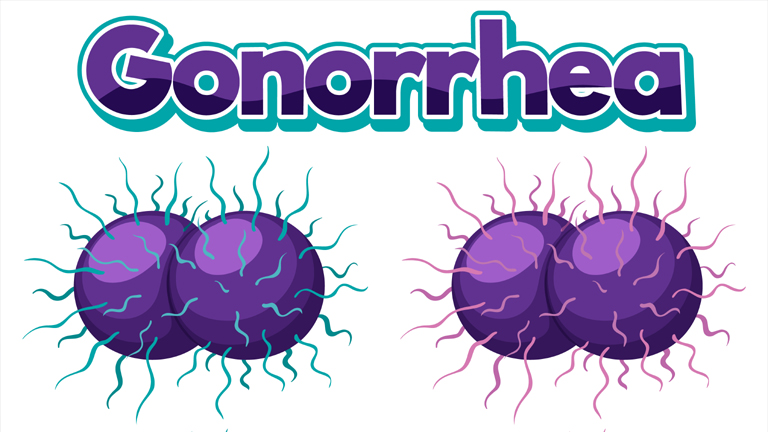 Gonorrhea