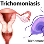 Trichomoniasis