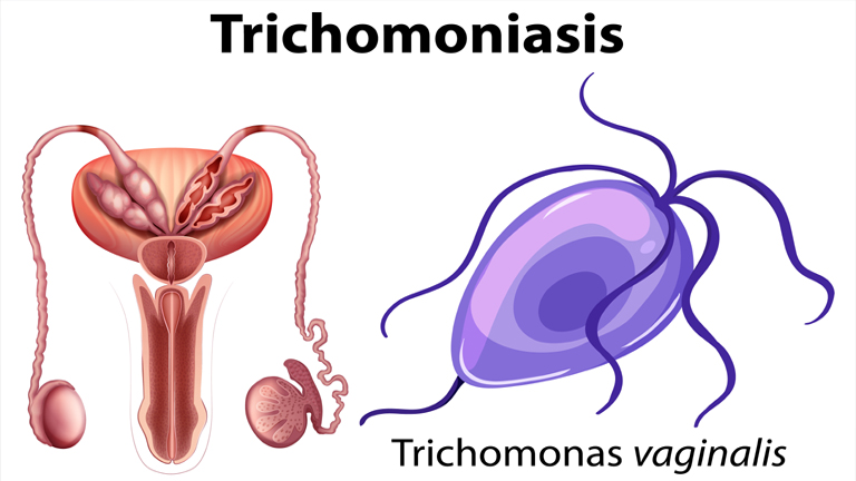 Trichomoniasis