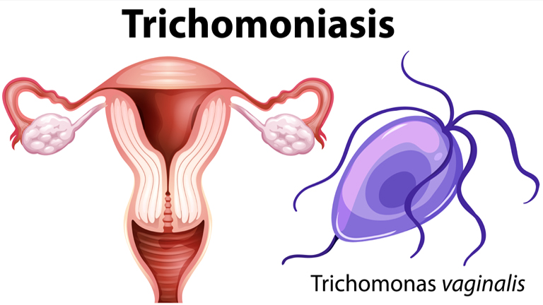 Trichomoniasis