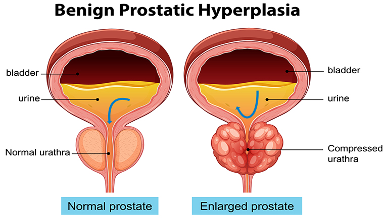 Benign prostatic hyperplasia