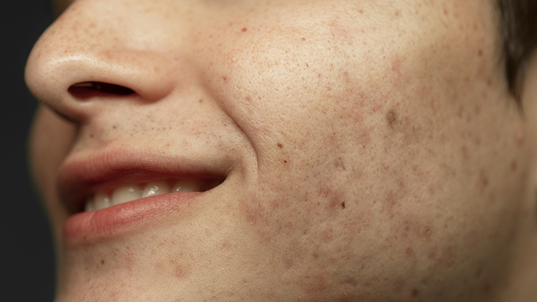 Home Remedies for Acne Scars