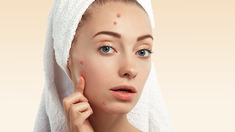 Home Remedies for Acne Scars