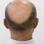 Male Pattern Baldness