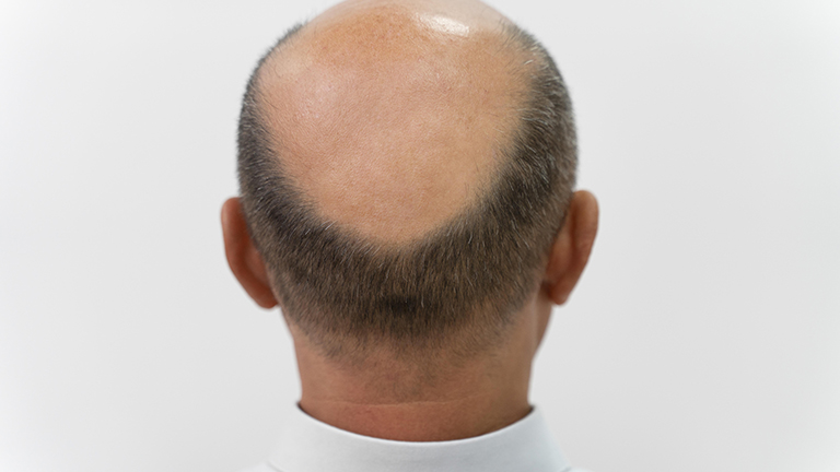 Male Pattern Baldness