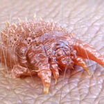 Scabies Treatment