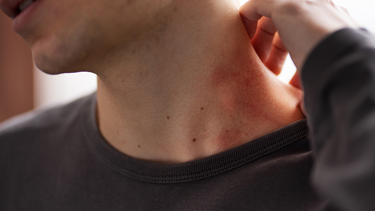 Scabies Treatment at Home Naturally
