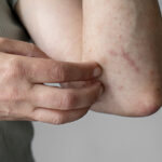Scabies Treatment at Home Naturally