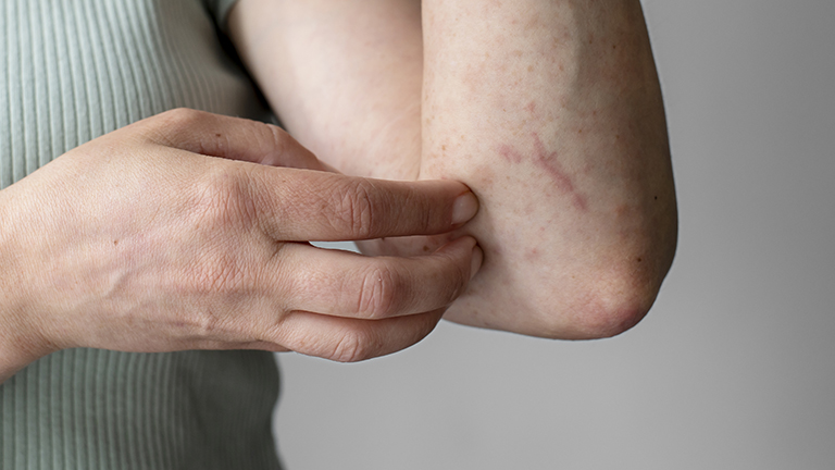 Scabies Treatment at Home Naturally