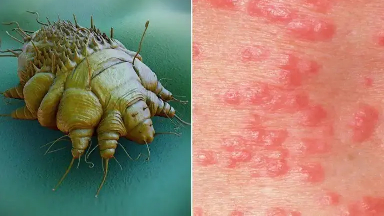 Scabies Treatment