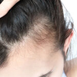 Stop Hair Thinning After Pregnancy