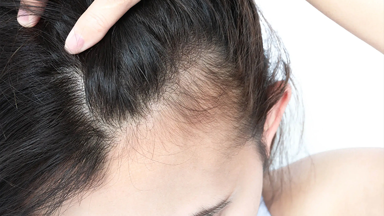 Stop Hair Thinning After Pregnancy