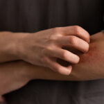 Symptoms of Chagas Disease