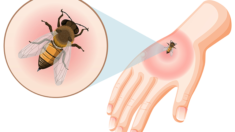 Symptoms of Chagas Disease