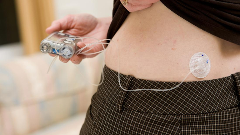 insulin pump therapy