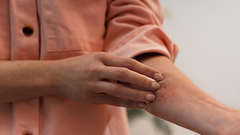 Lyme disease rash