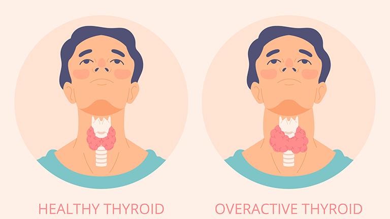 Thyroid disease symptoms