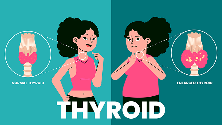 Thyroid disease symptoms